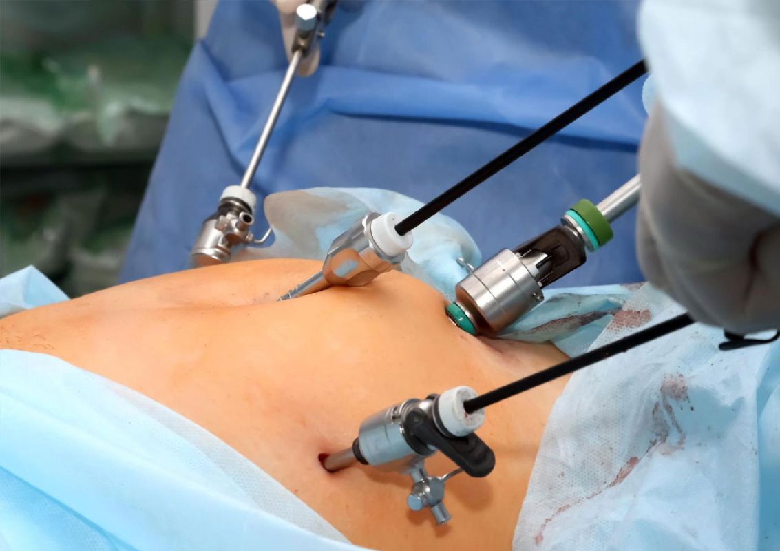 Top Minimally Invasive General Surgery Procedures in Bangalore