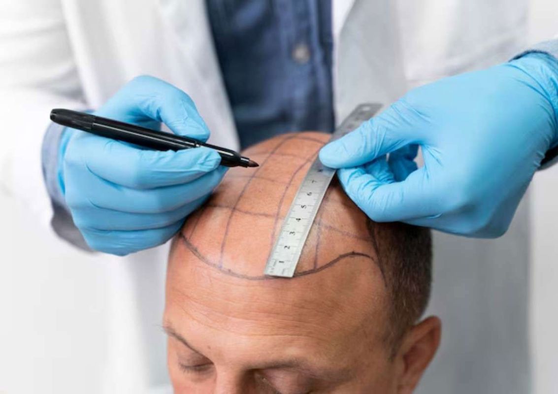 Is Hair Transplant Right for You? 5 Key Factors to Consider
